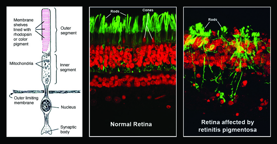 Left: Normal structure of rod cells of the retina. Center and right: Fluorescence-labeled cross sections of normal retina and those with advanced retinitis pigmentosa.. Courtesy of the American Foundation for the Blind